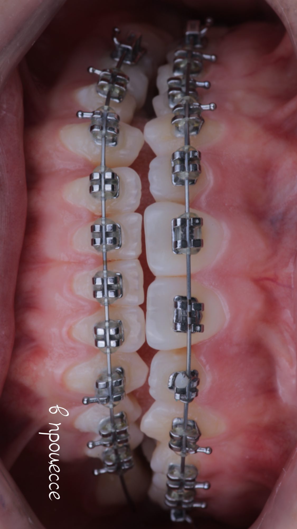 Реставрация зубов